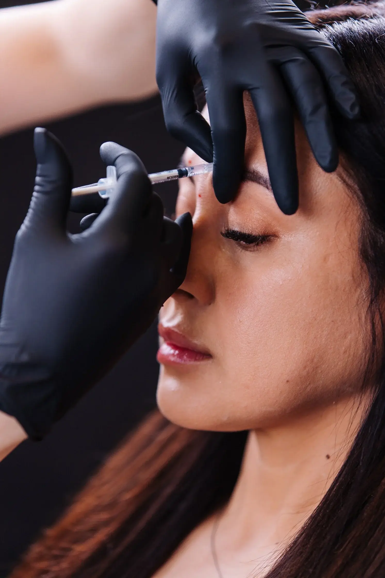 Neurotoxin injection near the brow, performed with a fine needle