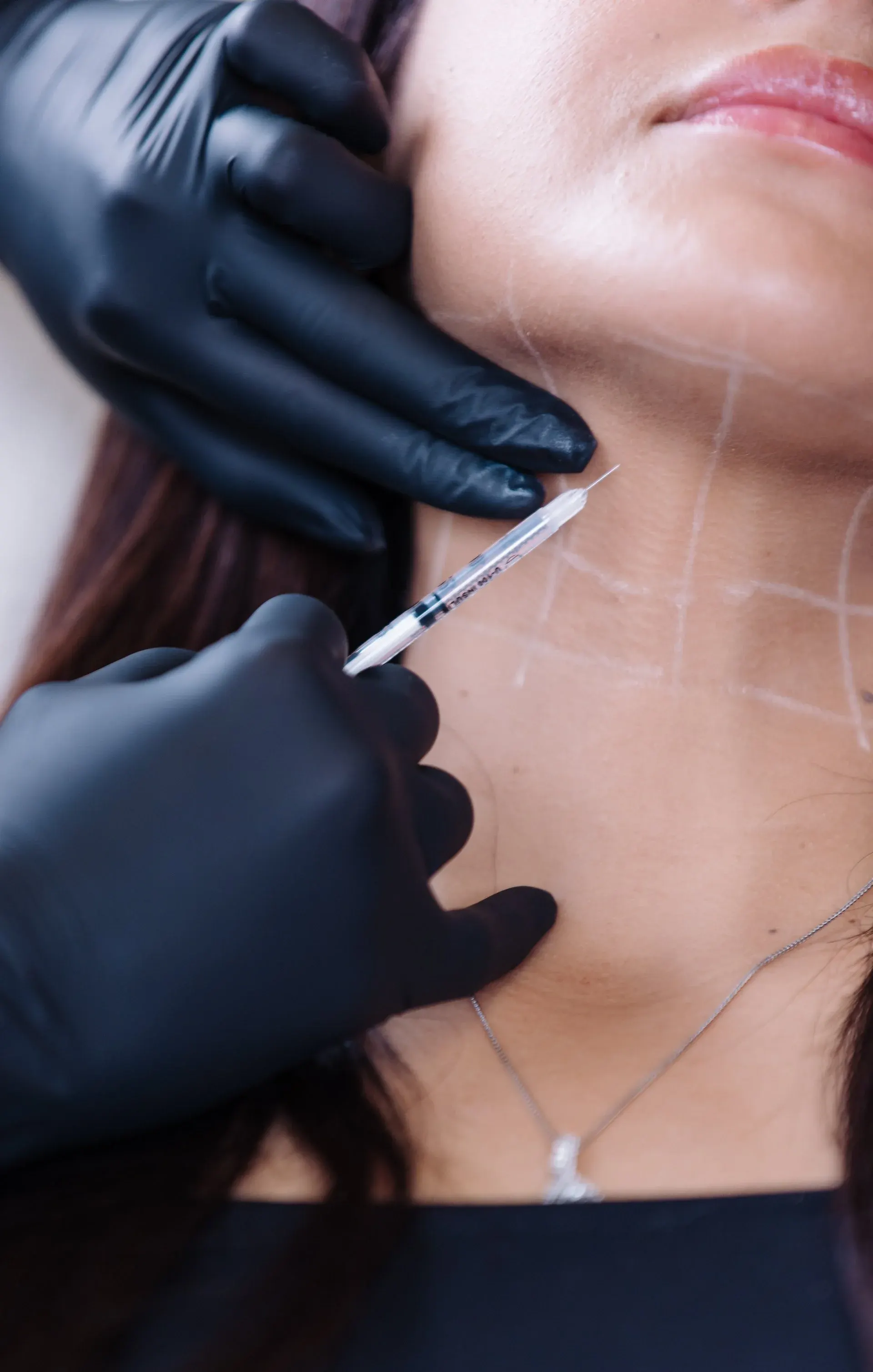 Kybella injection beneath a patient's chin, treatment grid marked on the skin