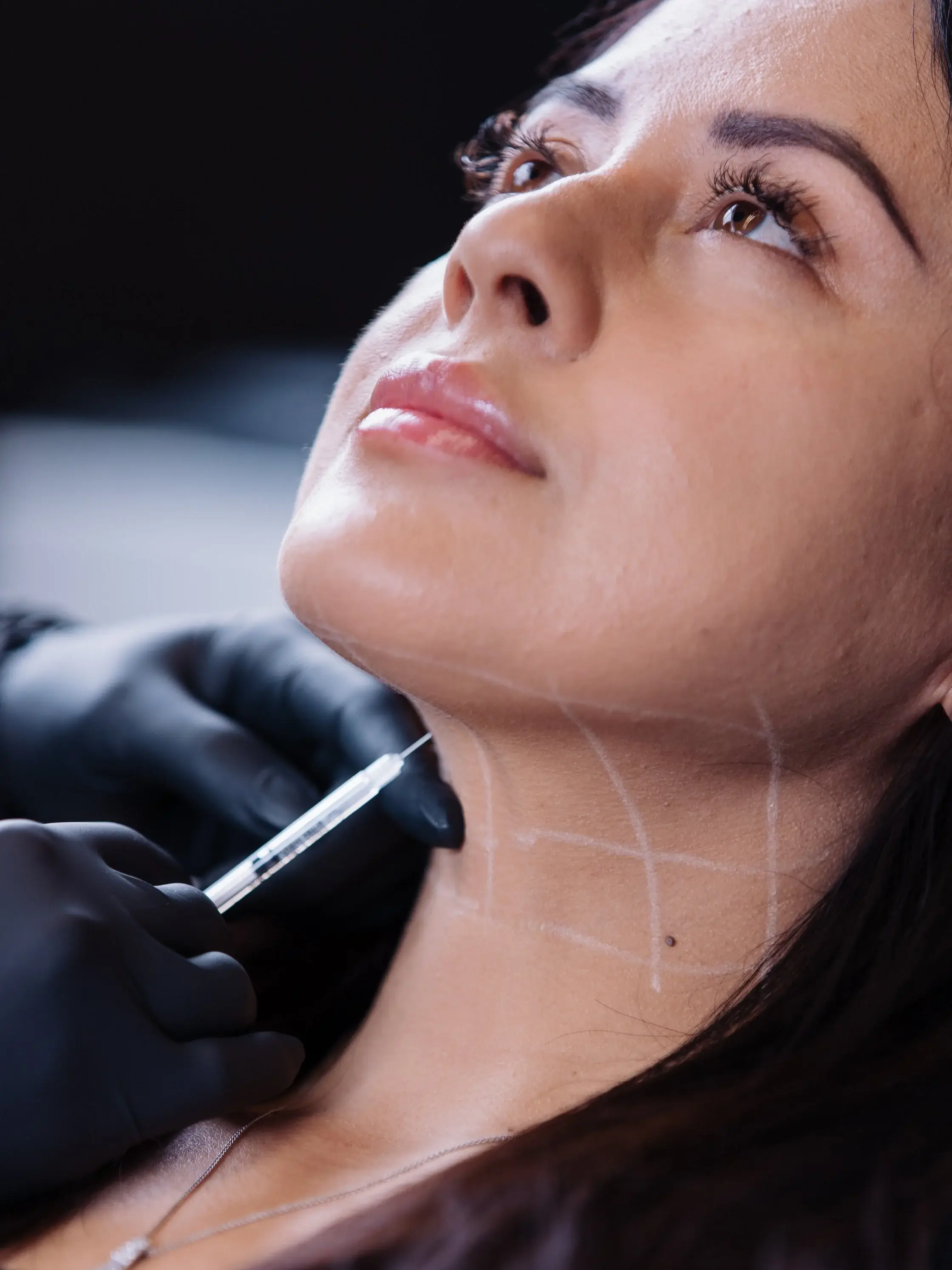 Patient with mapping lines along the chin and jaw before an injectable treatment