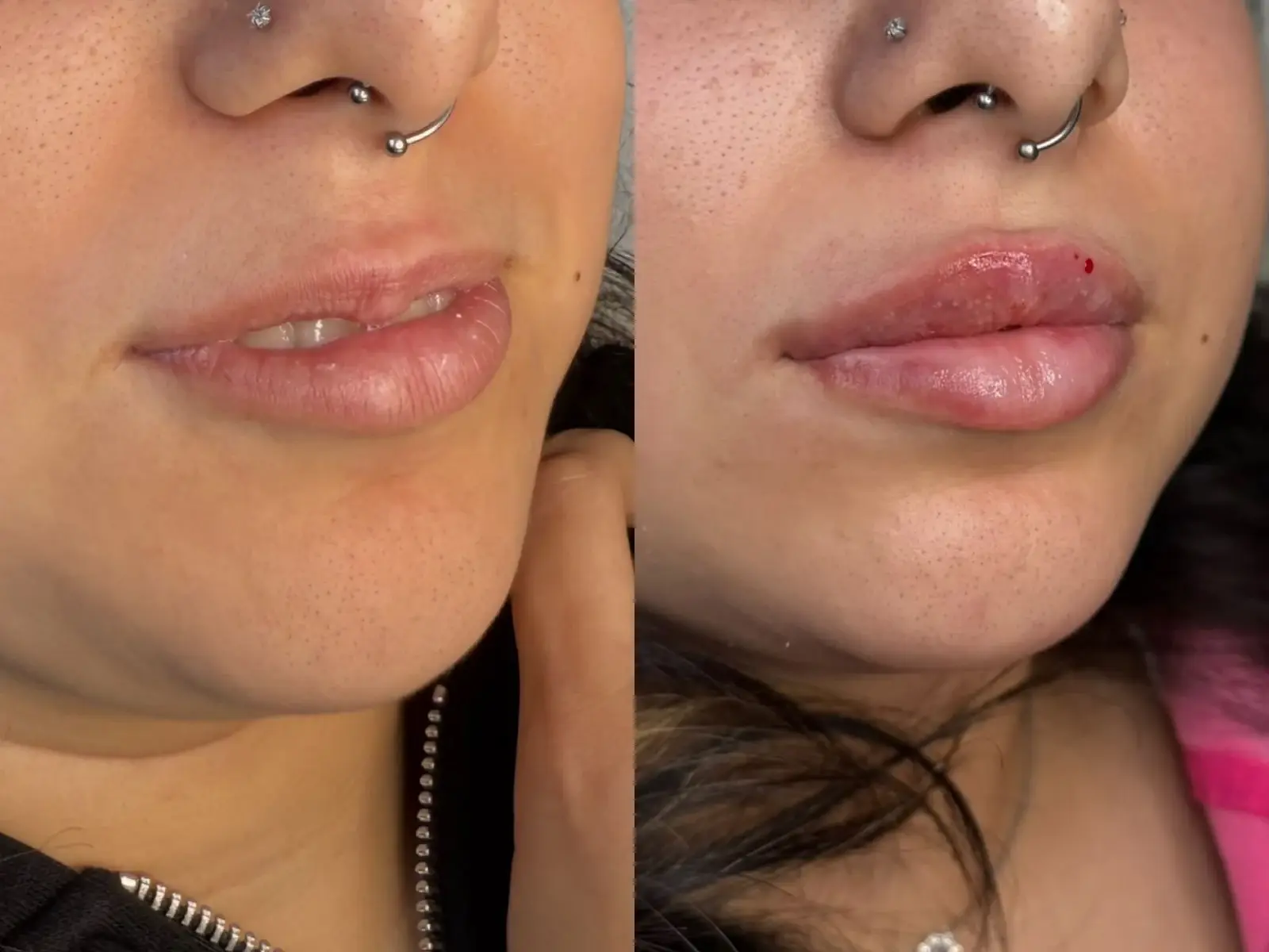 Two views of the mouth of a patient wearing a nose ring