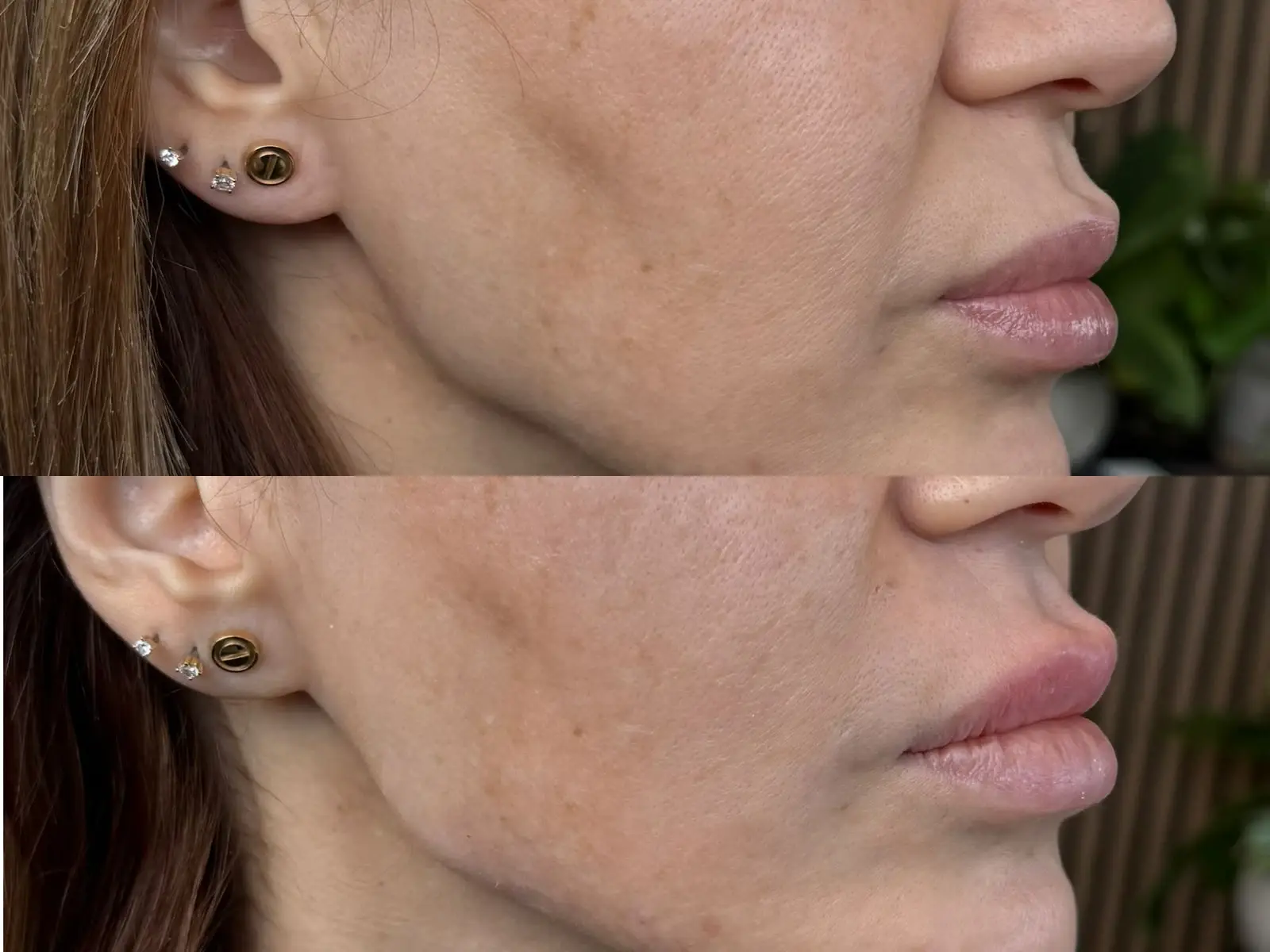 Two profile views of the jawline, stacked one above the other