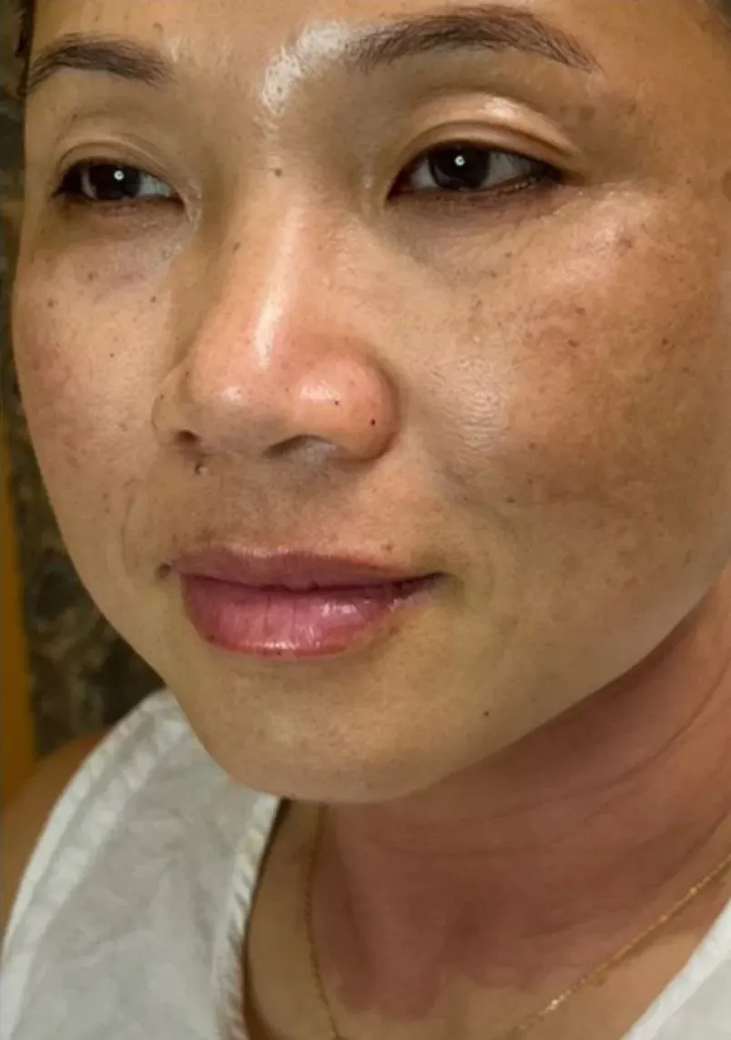 Lip enhancement patient, full face in view, after treatment