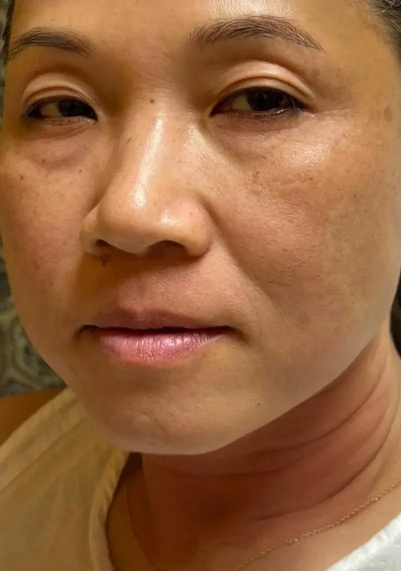 Lip enhancement patient, full face in view, before treatment
