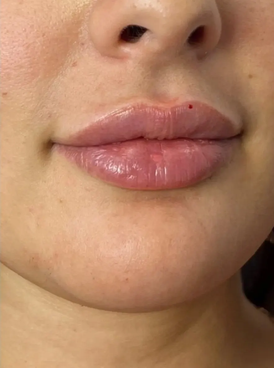 Lip enhancement patient, subtle volume, after treatment