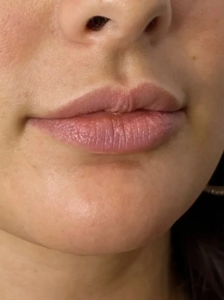 Lip enhancement patient, subtle volume, before treatment