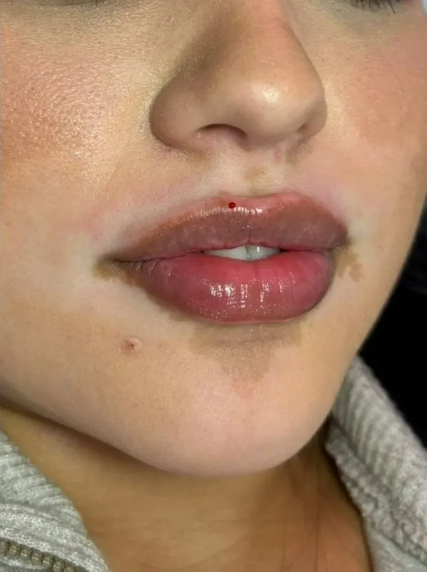 Lip enhancement patient, after treatment