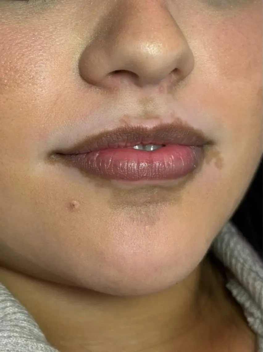 Lip enhancement patient, before treatment