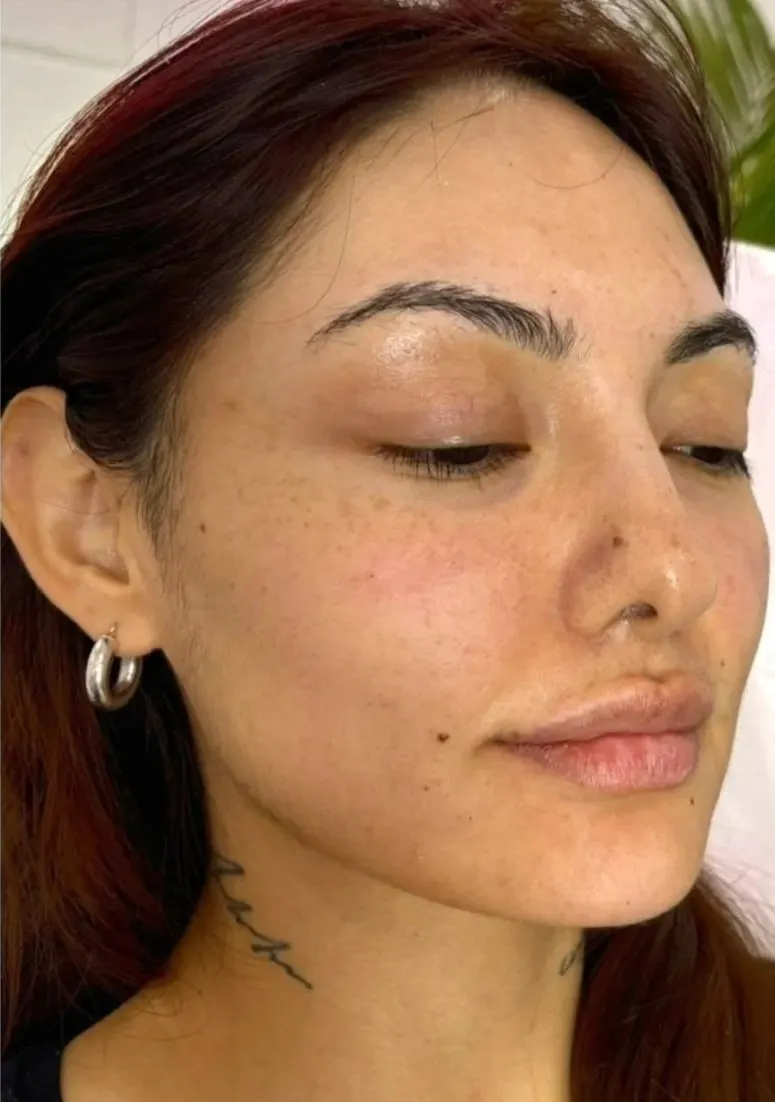 Lip enhancement patient, full face view, after treatment