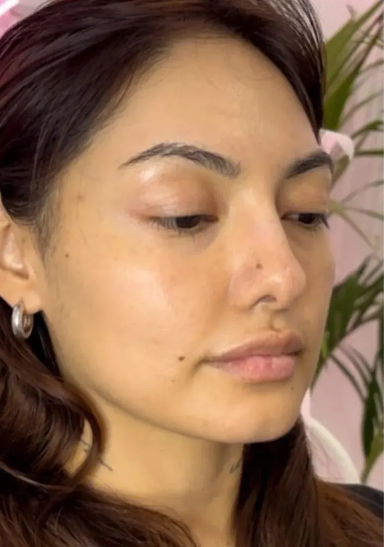 Lip enhancement patient, full face view, before treatment