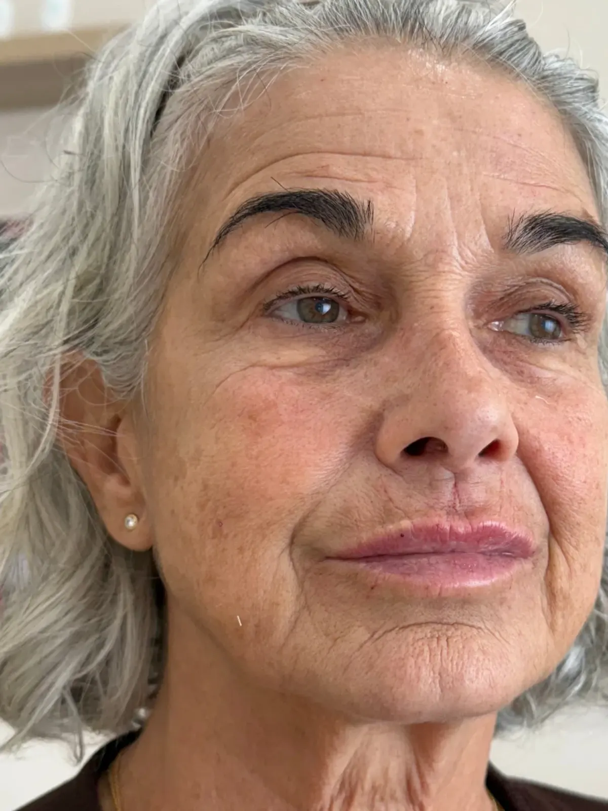 Patient with grey hair at a three-quarter angle, brow, cheek, mouth in frame, after treatment