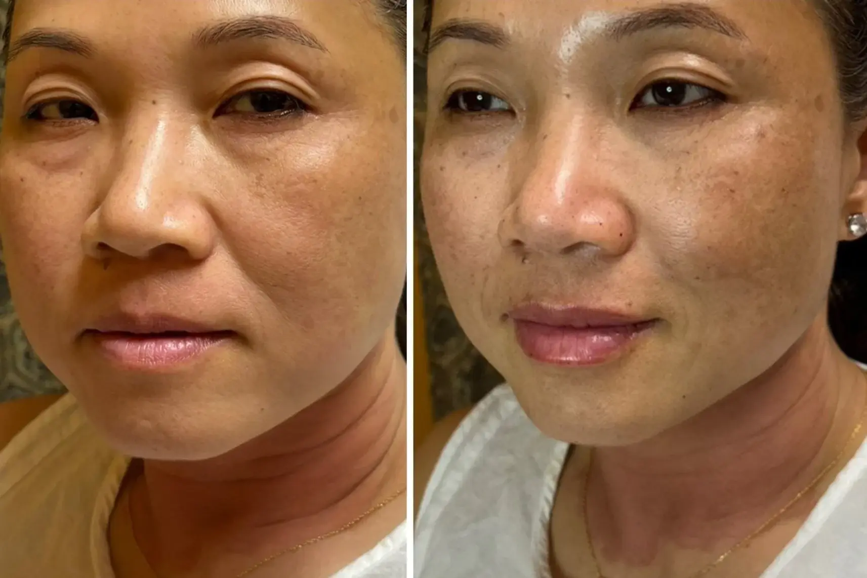 Original side-by-side, lip enhancement in context