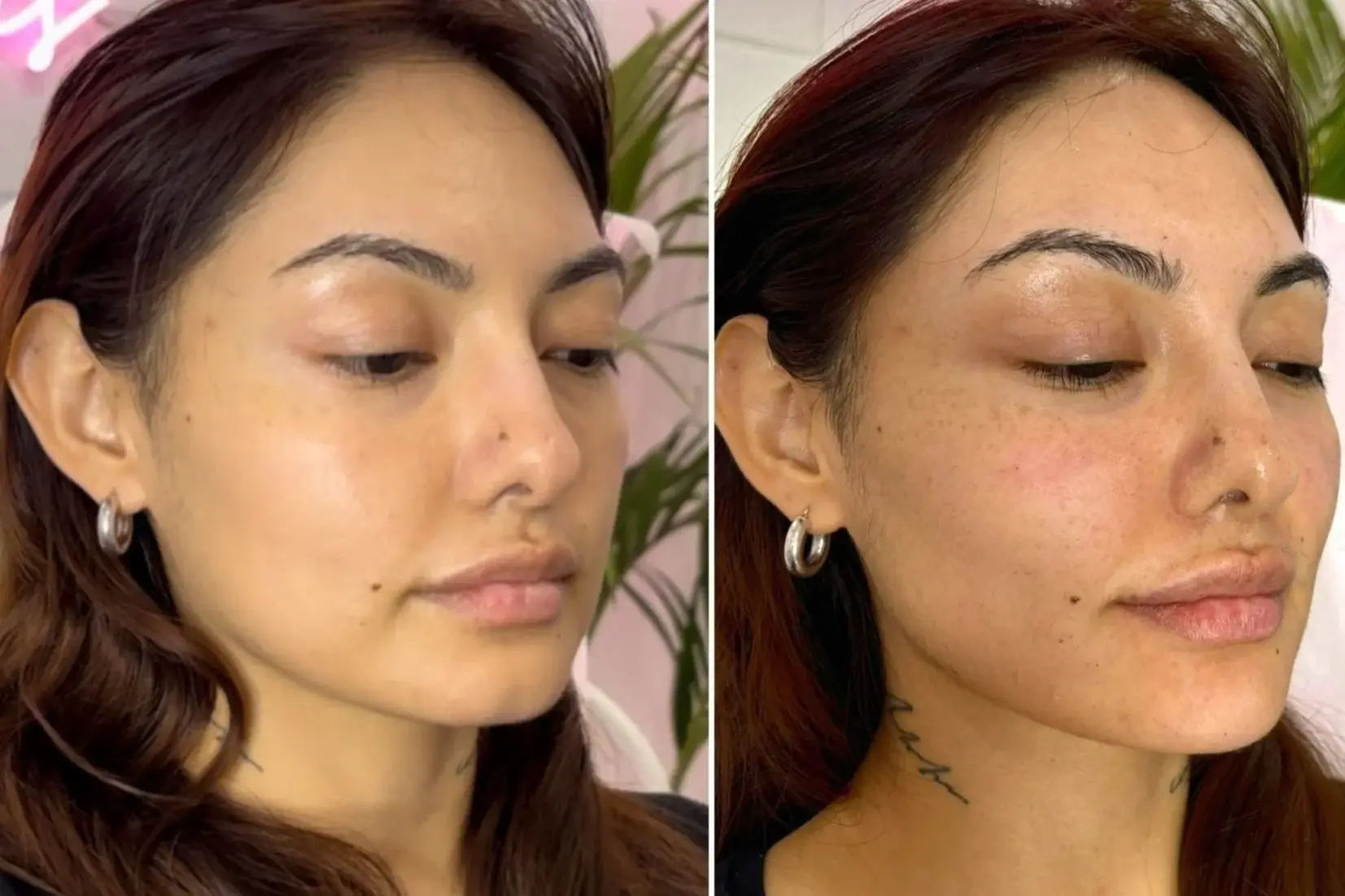 Original side-by-side, lip enhancement, full face