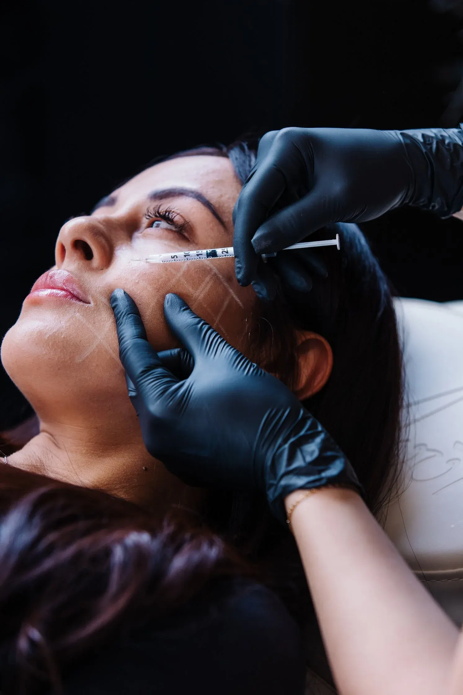 Patient receiving a precisely mapped injection, guide lines drawn across the cheek